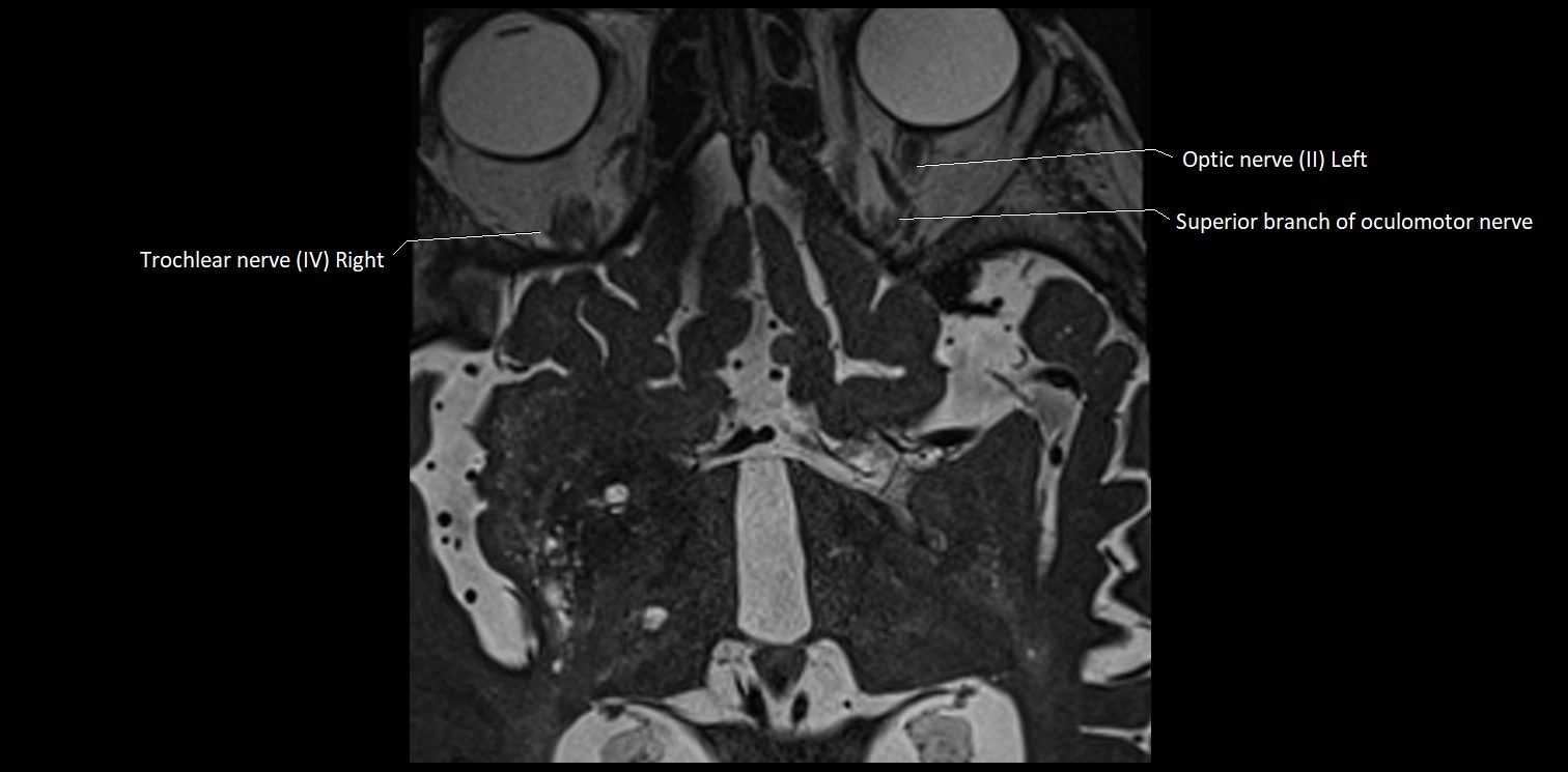 Cranial nerve anatomy axial MRI 3T image 2.webp